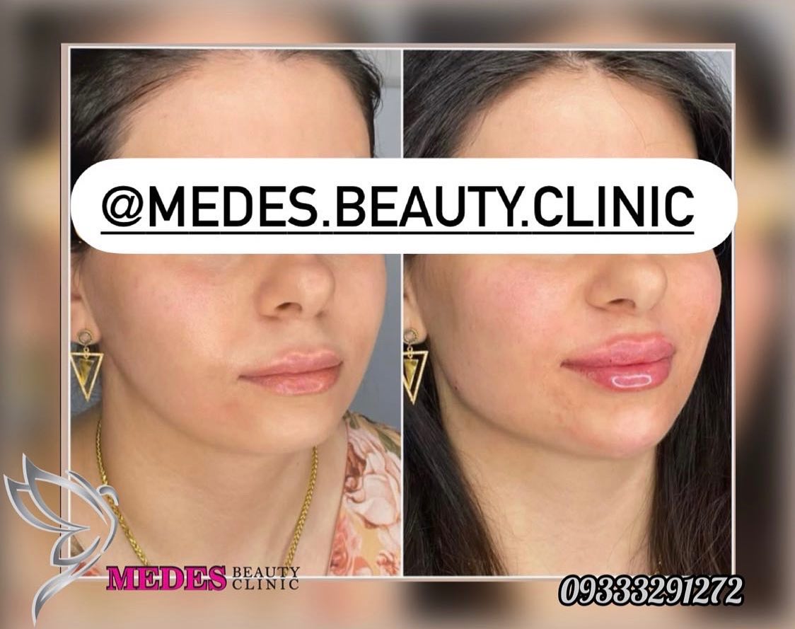 گالری زاویه سازی صورت